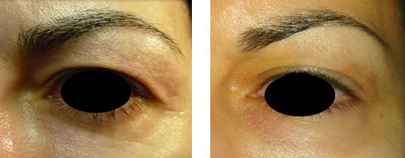 Blefaroplastia superior con laser de plasma Plexr en Malaga 2