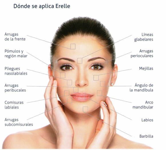 Erelle relleno facial en Malaga 2