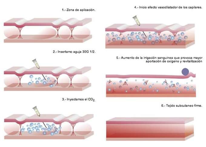 Tratamiento Carboxiterapia en Malaga 2