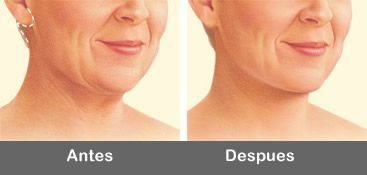 Tratamiento Cirugia de lifting facial y cuello en Malaga 1