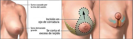 Tratamiento Mamoplastia de Reduccion de Pecho en Malaga 2