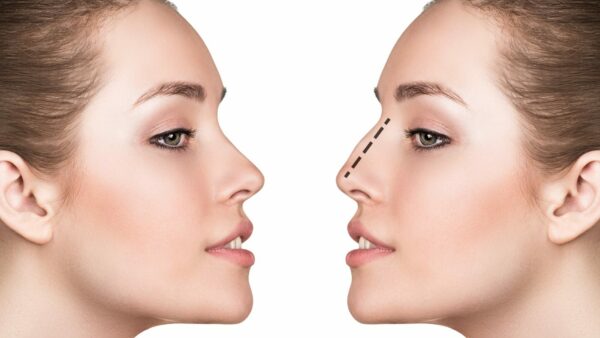 Tratamiento Rinoplastia – Cirugía de nariz en Malaga 1