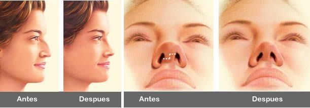 Tratamiento Rinoplastia Cirugia de nariz en Malaga 2