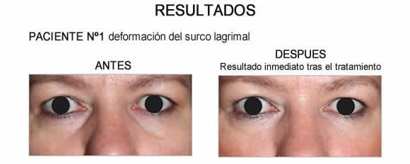 Tratamiento Tratamiento de ojeras con Redensity II 5