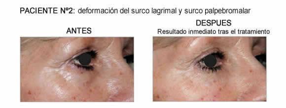 Tratamiento Tratamiento de ojeras con Redensity II 6