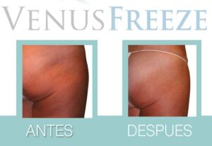Tratamiento Venus Freeze en Malaga 6