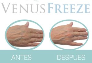 Tratamiento Venus Freeze en Malaga 7