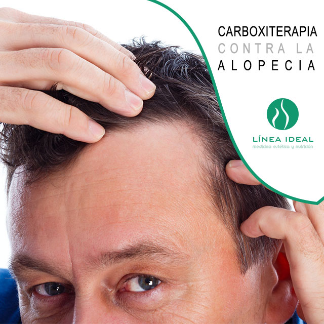 Blog Carboxiterapia contra la alopecia 1