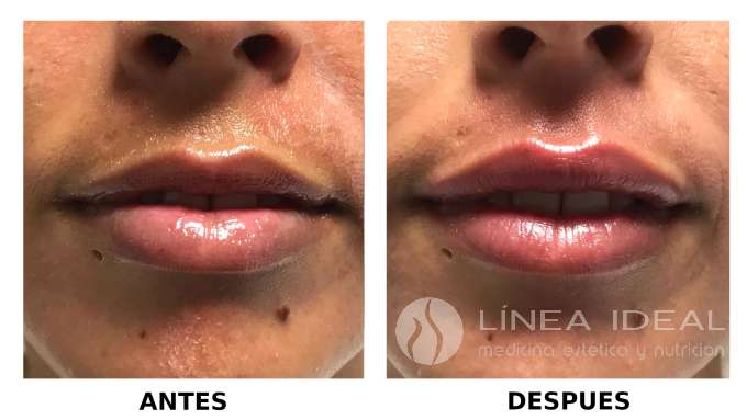 Tratamiento Aumento de labios Malaga 2