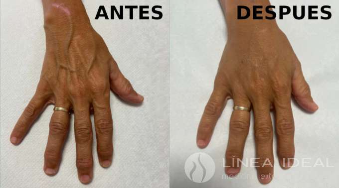 Blog Rejuvenecimiento de manos con acido hialuronico 2
