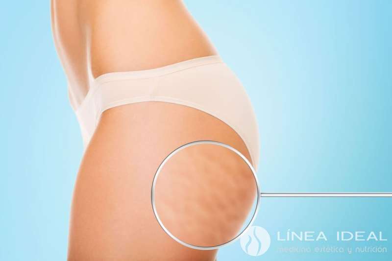 Blog Tratamiento de la Celulitis en muslos y gluteos 3