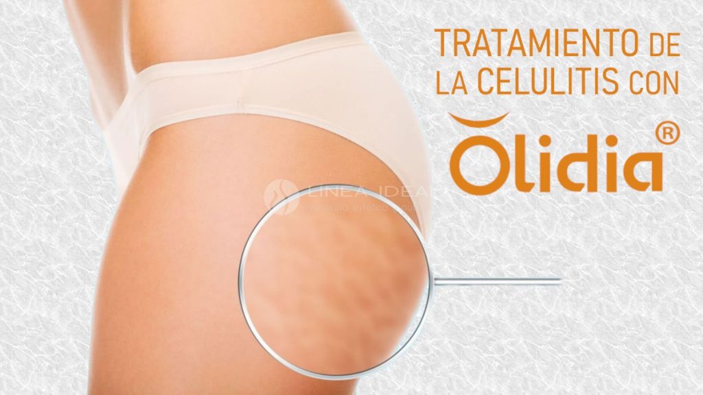 Blog Olidia® un innovador tratamiento de la celulitis flacida 1